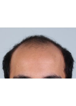 Before Hair Transplant&nbsp;Front